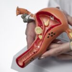 Kanker serviks merupakan kanker kedua yang paling umum terjadi pada perempuan di Indonesia. Namun, 70% perempuan terdiagnosis kanker serviks sudah memasuki stadium lanjut.